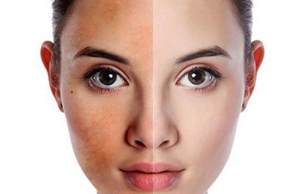 Danh sách 6 địa điểm spa chăm sóc da và trị nám hàng đầu ở Vũng Tàu